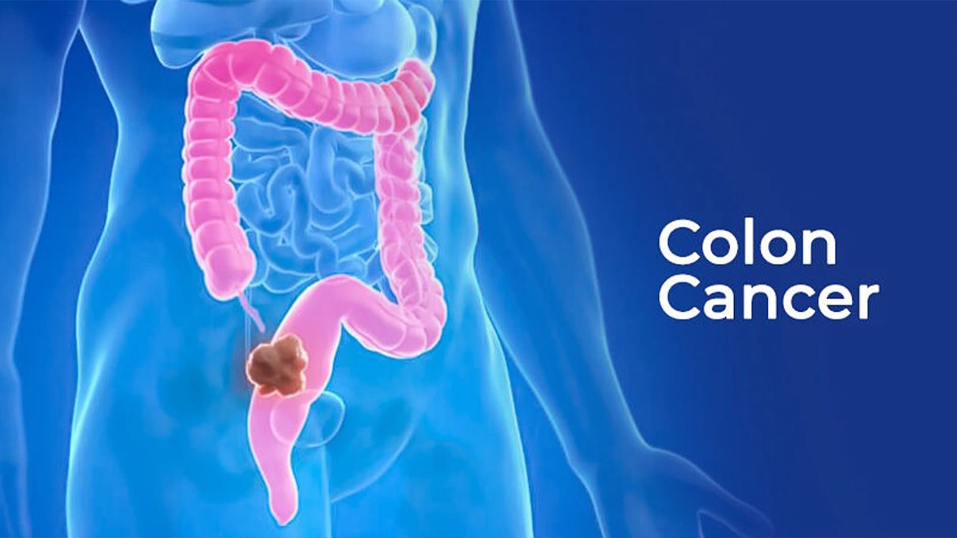 Global cancer burden to exceed $33.2 trillion, 35m cases yearly by 2050